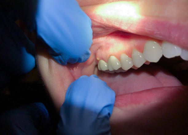Best Emergency Dental Care for Broken or Chipped Teeth in Camp Springs, MD